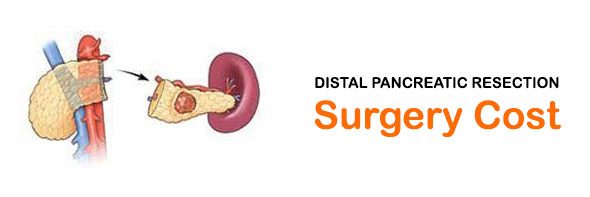 Distal Pancreatic Resection Surgery Cost in Mumbai, India