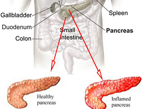 Acute Pancreatitis - inflammation & swelling of the pancreas
