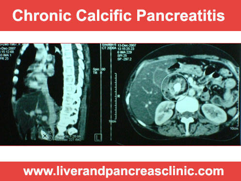 Chronic calcific pancreatitis treatment