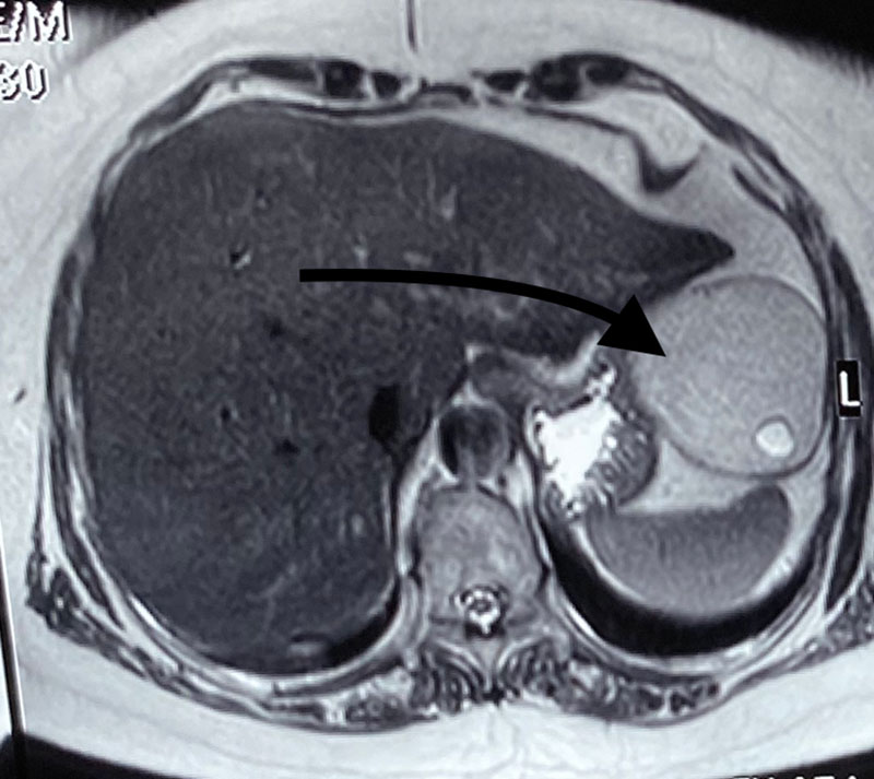 Laparoscopic Resection of Liver Hemangioma