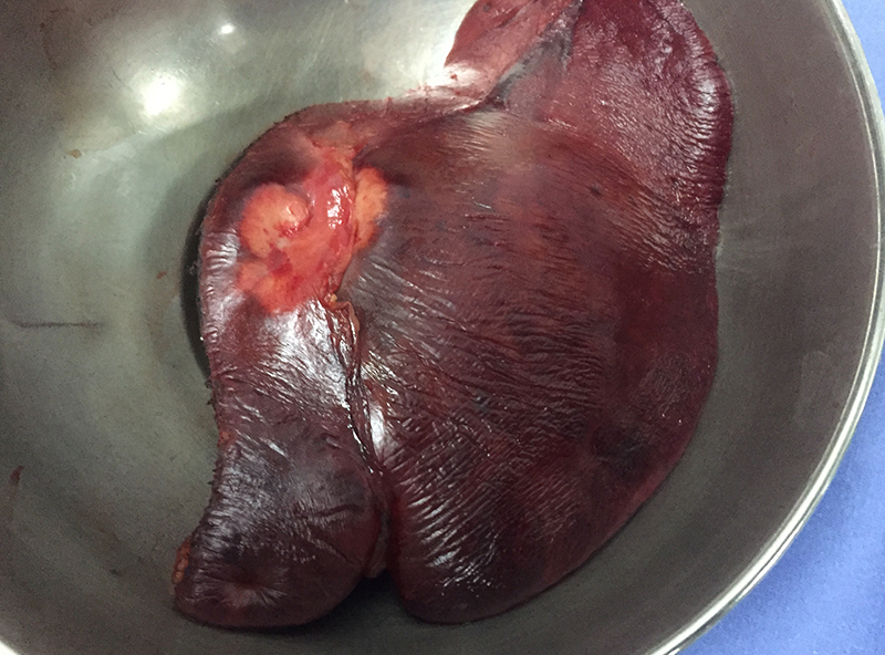 cholangiocarcinoma in the left side of liver