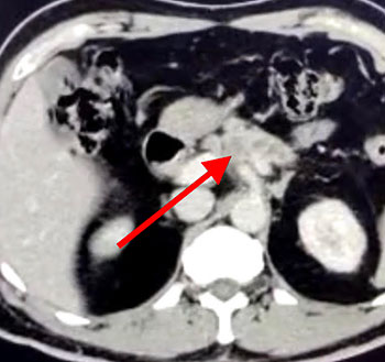 Cancer of pancreatic body CT scan