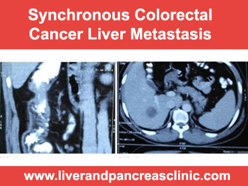 Treatment Of Synchronous Colorectal Cancer Liver Metastasis